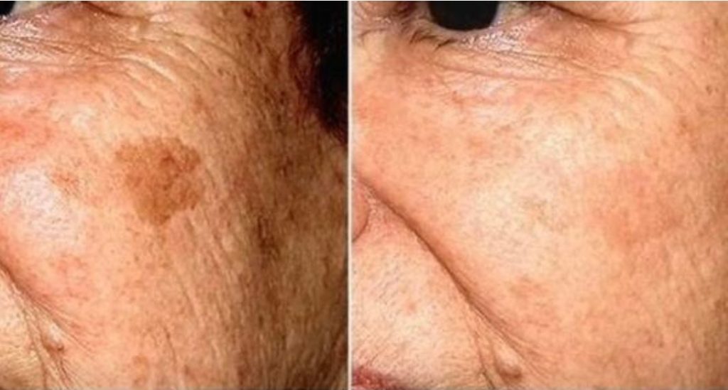 POZNATI DERMATOLOG OTKRIO: Ovo je uloga sode bikarbone u liječenju mrlja na licu!
