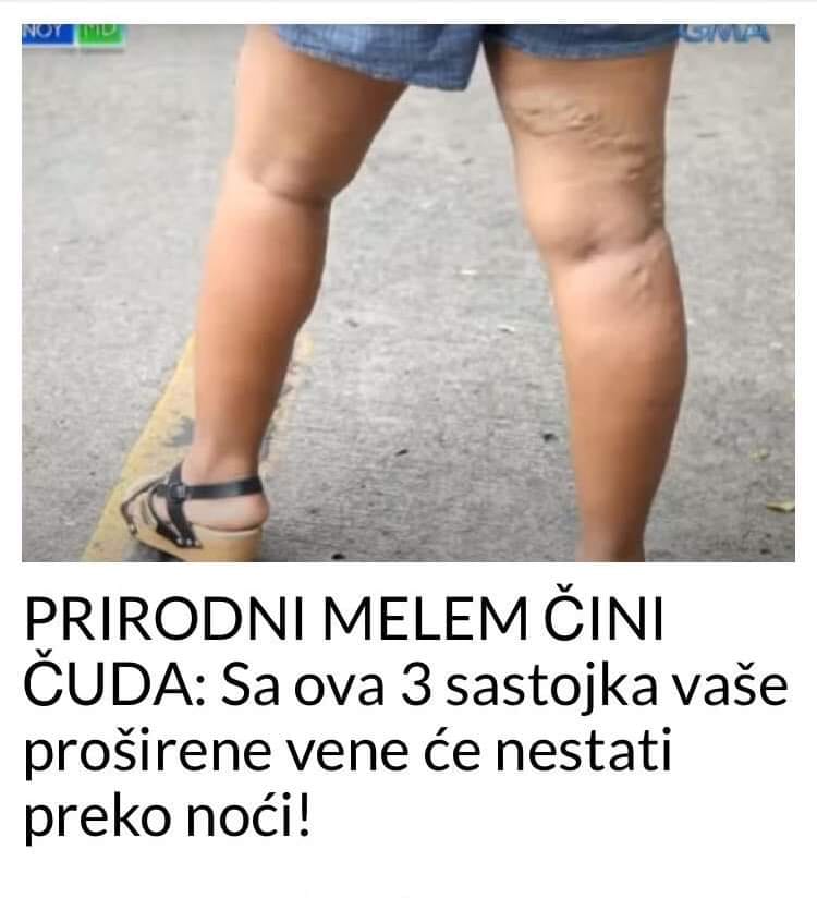 PRIRODNI MELEM ČINI ČUDA: Sa ova 3 sastojka vaše proširene vene će nestati preko noći!