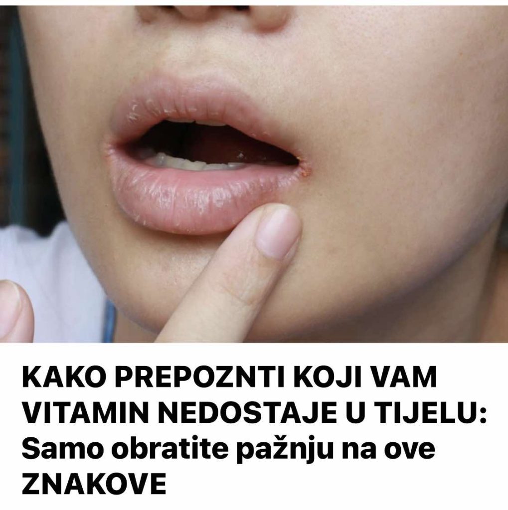KAKO PREPOZNTI KOJI VAM VITAMIN NEDOSTAJE U TIJELU: Samo obratite pažnju na ove ZNAKOVE