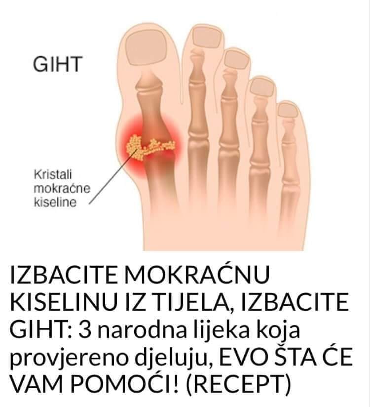 Evo tri narodna lijeka za giht kojima je cilj eliminirati mokraćnu kiselinu iz tijela, što predstavlja potencijalno rješenje za one koji traže olakšanje